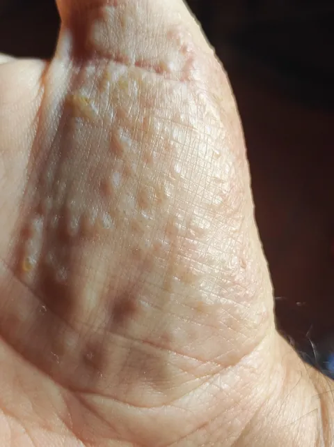 My dermatitis has evolved in just four days, and it only appears when I'm particularly stressed, always in the same spot. It's so itchy, it's a nightmare to work with.