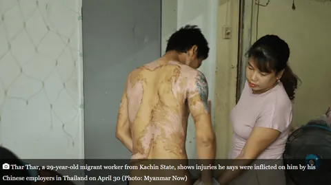 A Myanmar migrant worker Mr. Thar Thar survived a brutal 5-hour torture ordeal by Chinese employers in Thailand. While working at the construction site, his wages were withheld for months. He was later lured, beaten, and severely burned with boiling water before narrowly escaping.