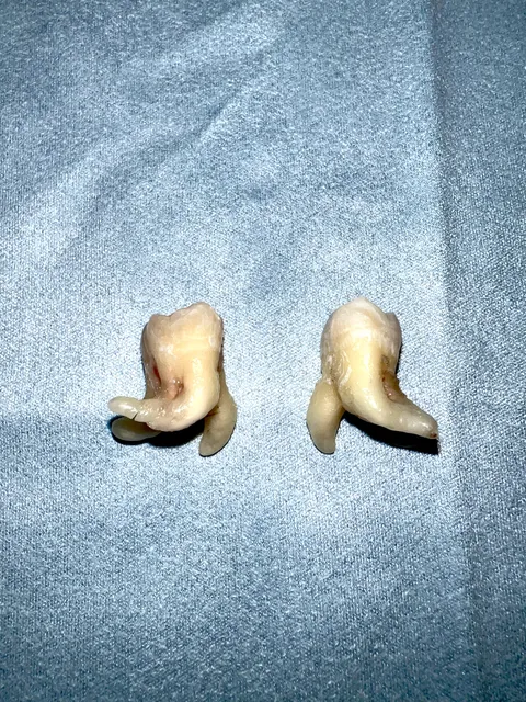 Got my wisdom teeth taken out today