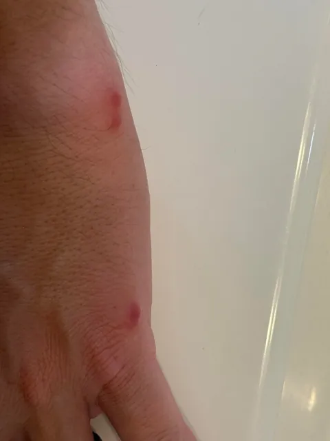 Went on vacation, hotel had bed bugs.