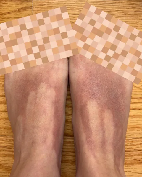 Didn’t completely cover my feet in sunscreen. Got a nasty burn. You can see exactly where my fingers stopped.