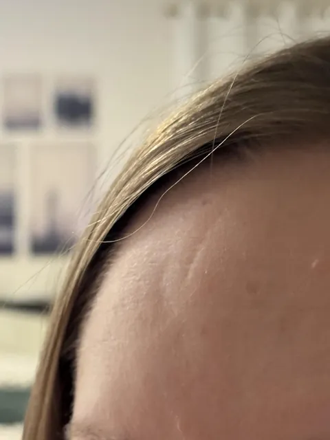 The dent in my skull and the scar from the original accident no longer line up