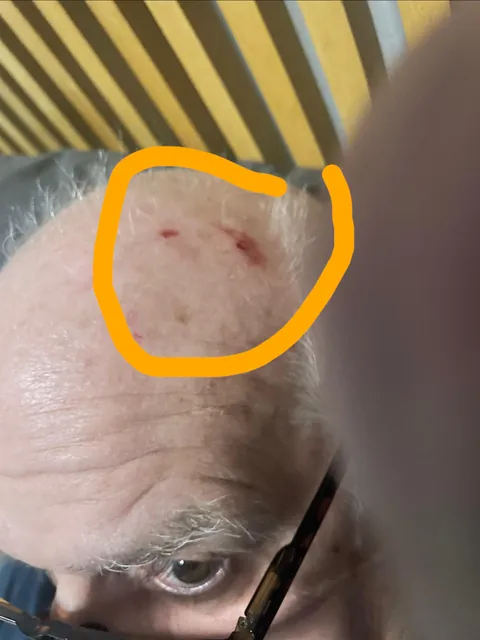 Glass is now coming out of my Dad’s head 60 years later. In the 1960’s, he was in a car crash and he hit the windshield.