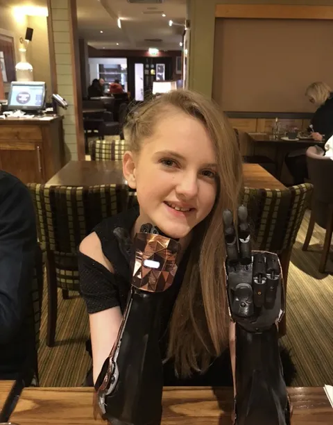 Tilly lost her hands as a baby. Now she's bionic! ✌️
