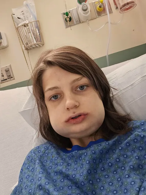 19, I had jaw surgery and thought this would be a funny one. Second photo is maybe an hour after post op!