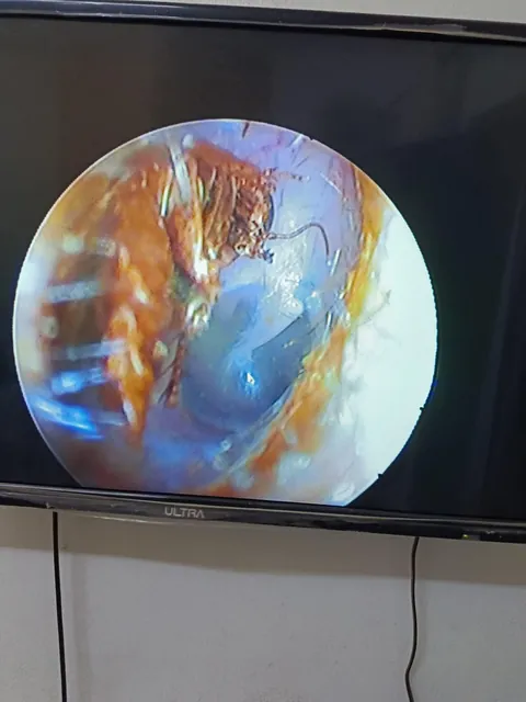 they found a cockroach in my ear