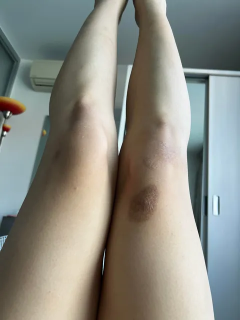 Just me and my imperfections. (27f/164cm/70kg)