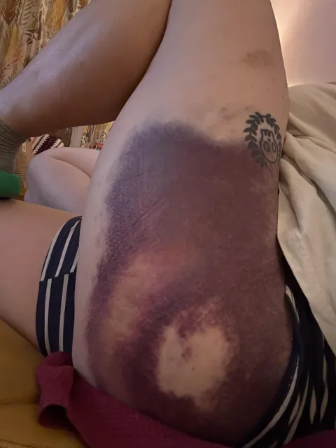 Mega bruise from e-scooter fall