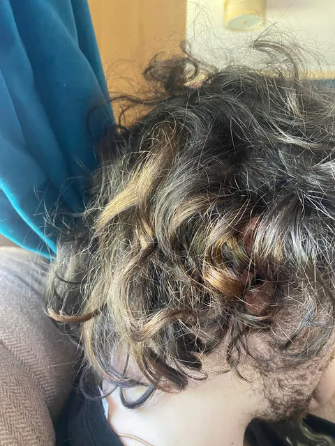 My son has a blonde birthmark