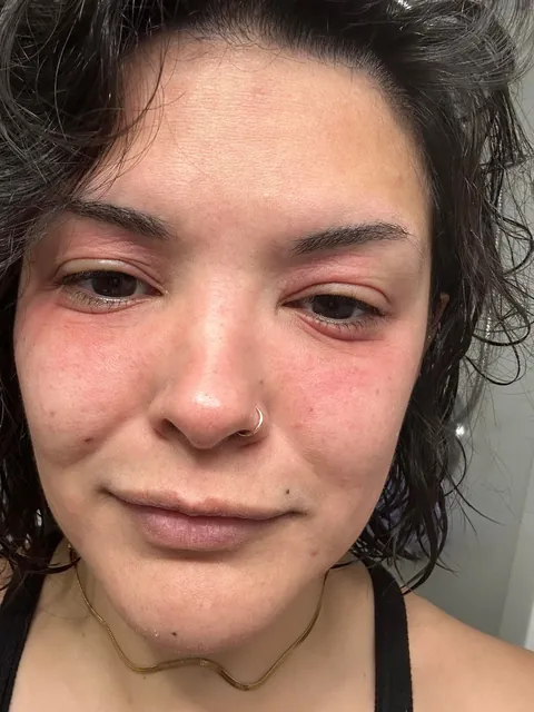 Watch my eyes blow up from the arnica in my concealer