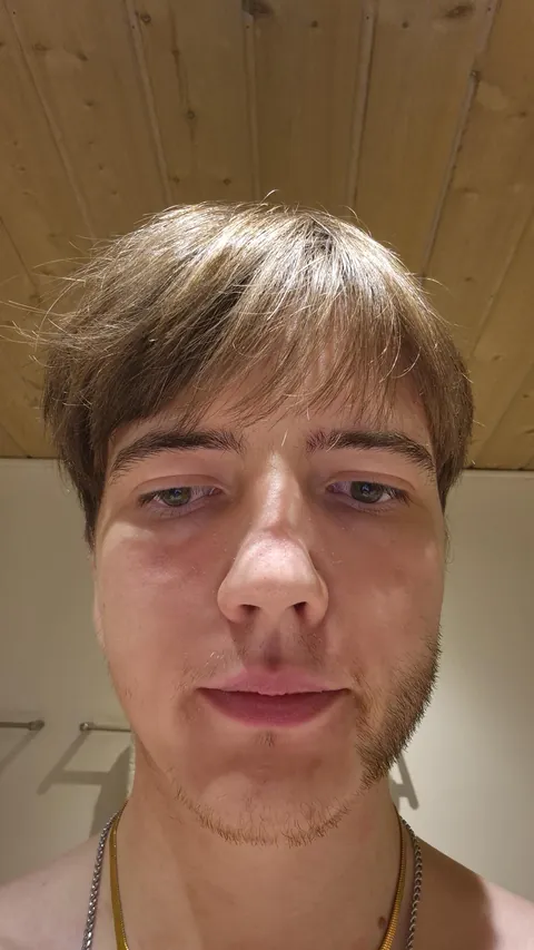 I dont grow beard on the left side of my face