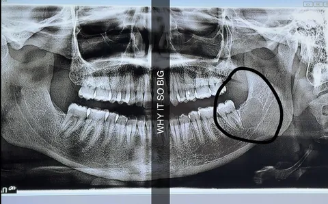 Got oral surgery based on 90% probability, ended up being 10%