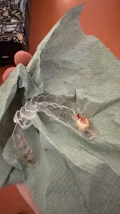 My daughter’s Invisalign pulled her baby tooth out