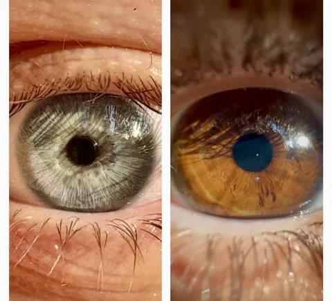 Why does the iris of my eye (left) look so “stringy” and striated compared to my friends eye (right)?