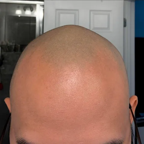 Got my head tattooed! 6 month healed > Fresh > Before