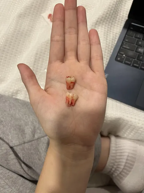 My three rooted tooth vs a normal tooth