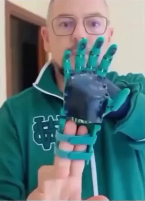 A child with a missing hand gets prosthetic one