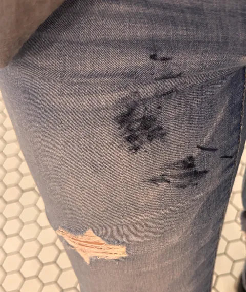 sharpie leaked all over my blue jeans at work. is there any way to completely get rid of this?
