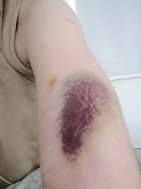 Fell asleep on my headphones and it's left this pattern on a bruise. Still there over a day later