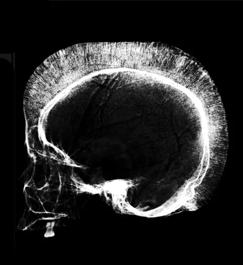 Skull in beta-thalassemia.