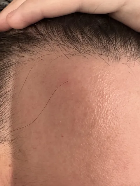 Despite my hairline receding years ago, one hair follicle continues to grow at my original hairline