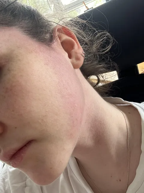 My face goes red only on the edge when i exercise