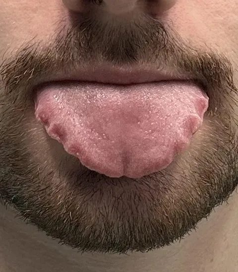 The shape of my tongue due to wearing retainers at night 