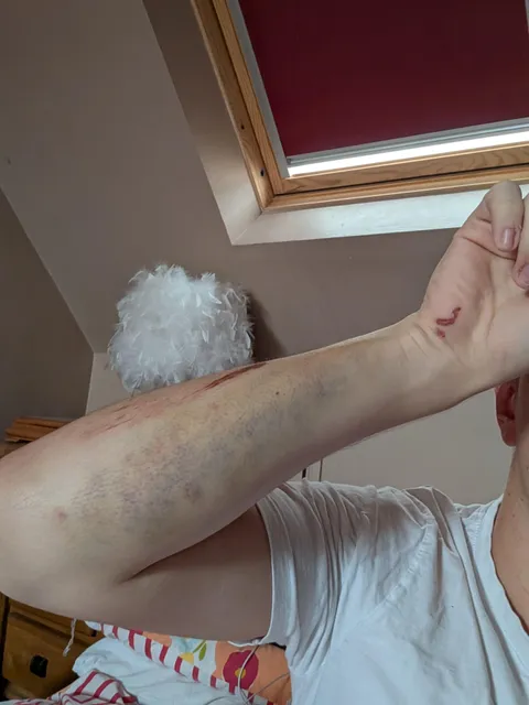 Slept walked off my neighbours roof, my thigh looks pretty similar