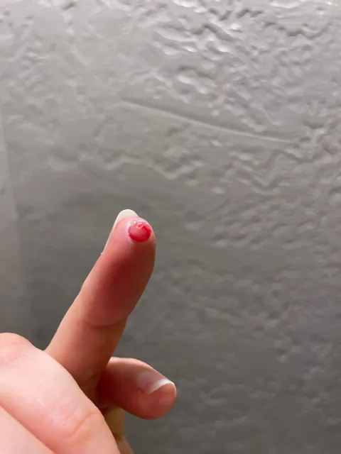 A blood blister on my fingertip popped, now I have a lump of flesh protruding through the hole.