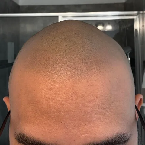 Got my head tattooed! 6 month healed > Fresh > Before