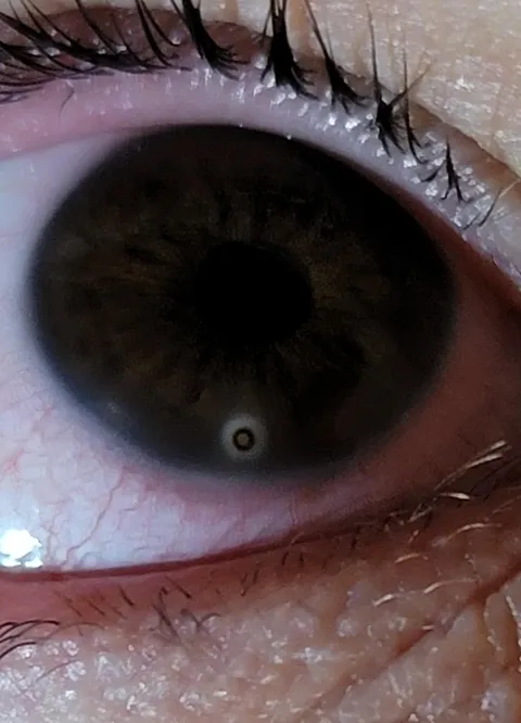 I got a piece of metal stuck in my eye and it left a rust ring after it fell out