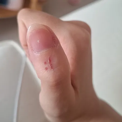 The wound on my thumb looks like a :(