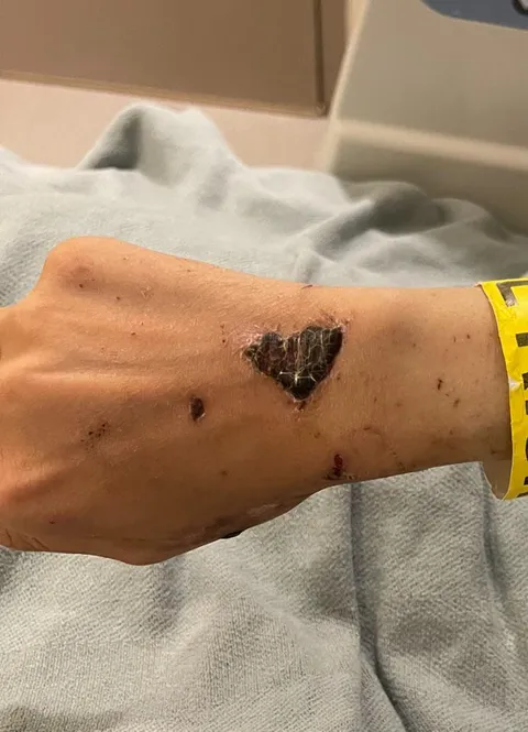 Heart shaped scab left after near fatal accident