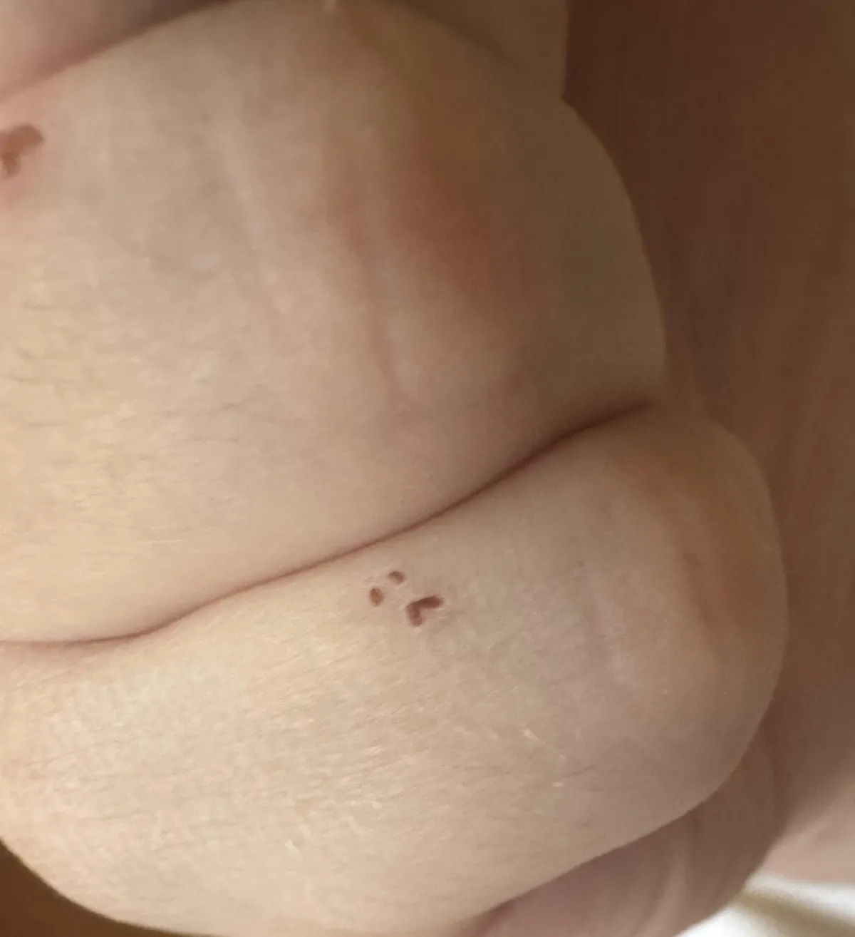 I got a scrape on my pinky and it scabbed into a frowny face.