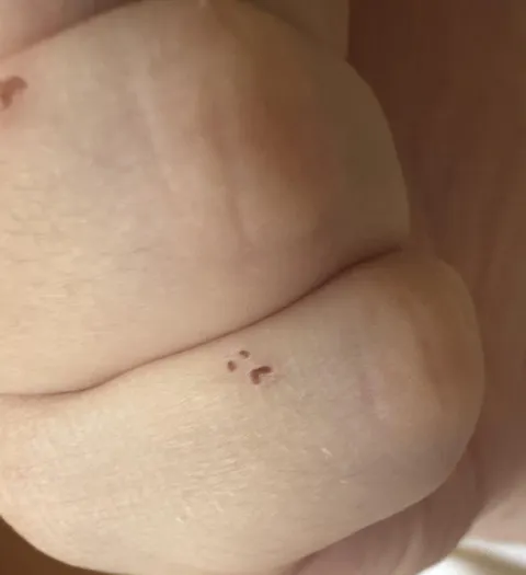 I got a scrape on my pinky and it scabbed into a frowny face.