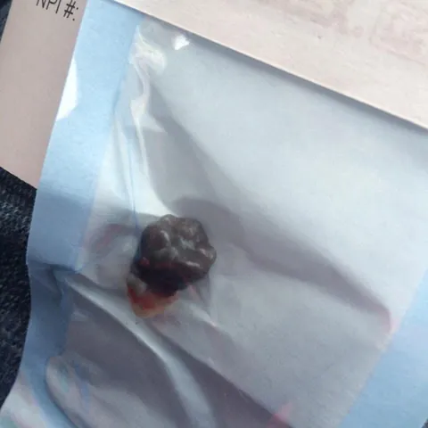 I had a black wisdom tooth