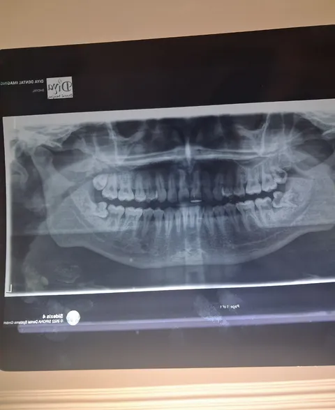 Found out I have all four wisdom tooth impacted