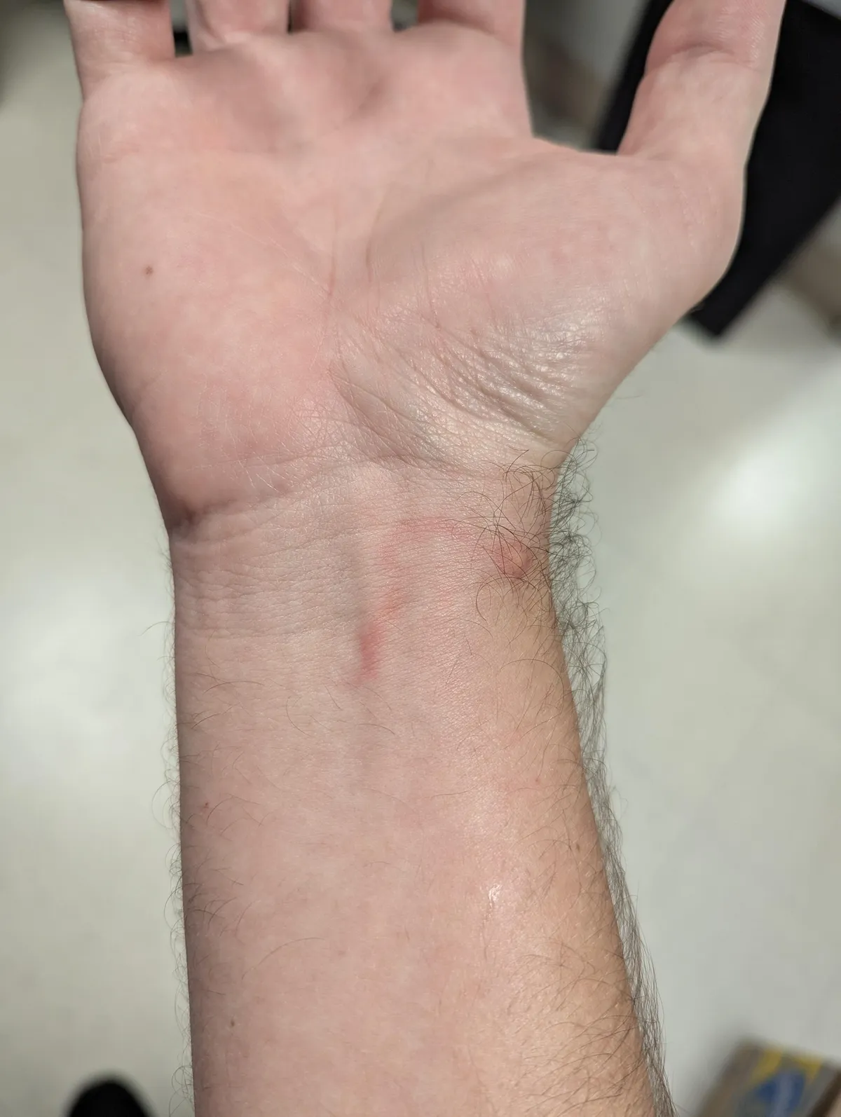 Got bit by a fire ant and it made a trail on my wrist