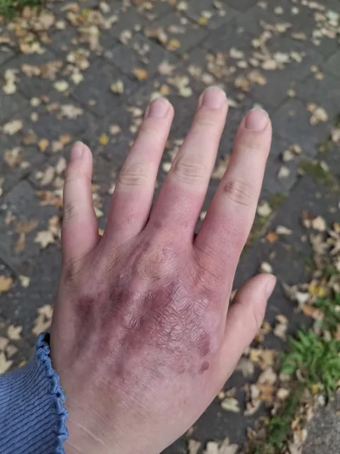 My hand is still red in cold weather on the same spots after burning it 6 month ago