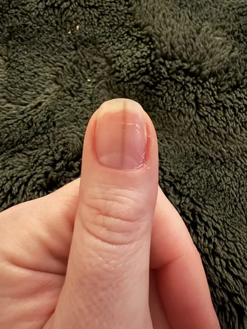 Dark Tan line showed up on my thumb nail, won’t go away.