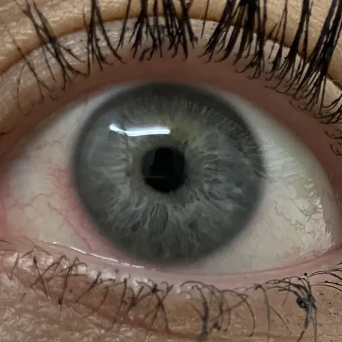 It cost me $200 to learn this thing on my eye is just… permanent.