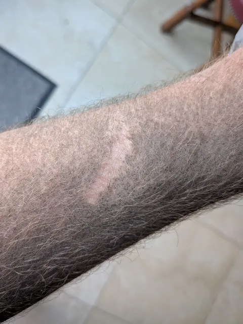 My old scar is dust repellent.