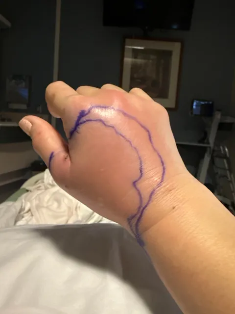 Just a reminder how serious cat bites can be!