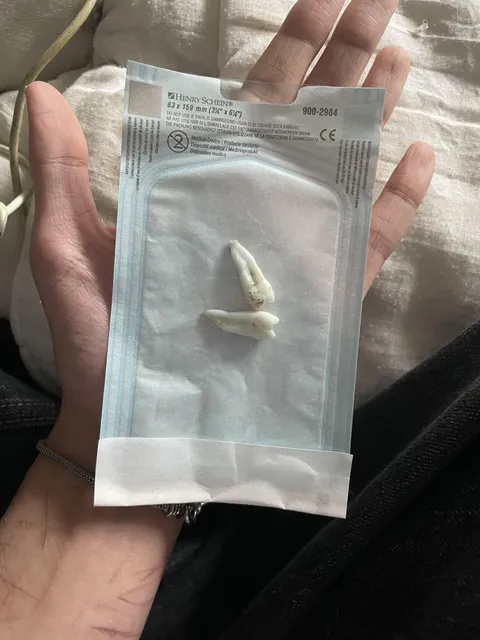 Specialist dentist said I had some of the longest teeth he’s ever removed. 