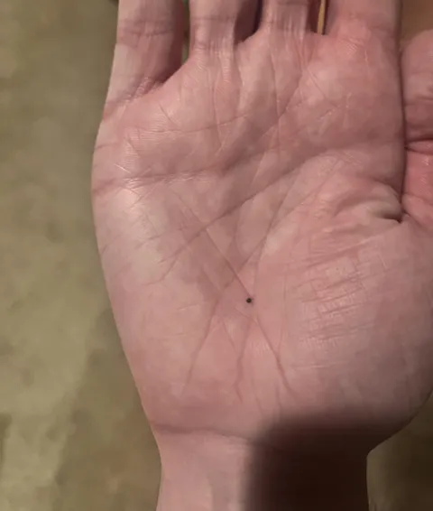 Random black dot appeared on my hand three days ago