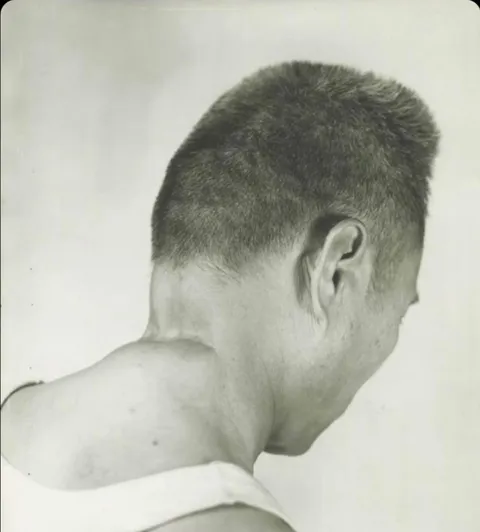A filipino survivor of the Manila massacre, shows where a Japanese officer tried to behead him. 1945.