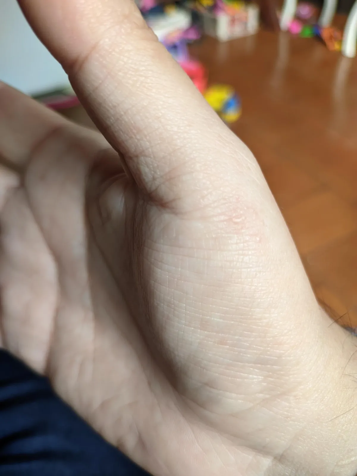 My dermatitis has evolved in just four days, and it only appears when I'm particularly stressed, always in the same spot. It's so itchy, it's a nightmare to work with.