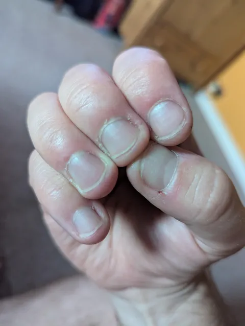 Doesn't look much but I've been biting my nails since I can remember, I've got nails! (M34)