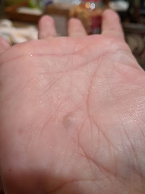 A rock working its way out of my hand after a bicycle accident over 25 years ago.