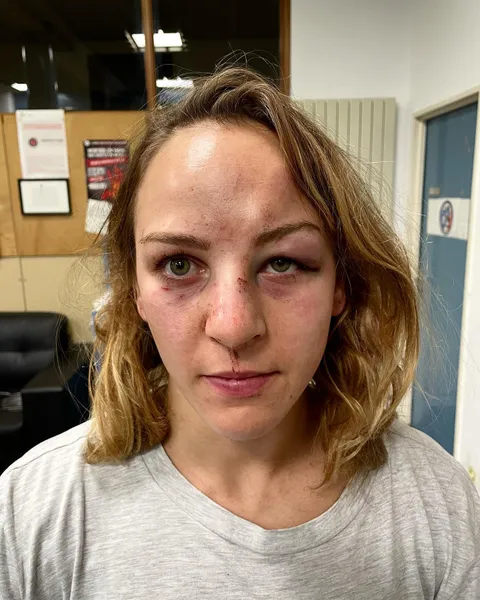 Olympic gold medalist in Tokyo Margaux Pinot posted her picture on social media after being attacked by her partner Alain Schmitt which was arrested yet released after a day